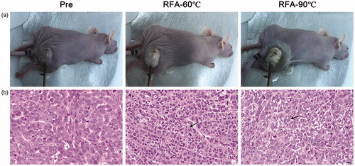 Figure 5. Representative histological images of tumors pre and post RFA. (a) Macro images. (b) H&E staining images. Arrows showing representative areas of coagulation necrosis with nuclear fragmentation and that the normal morphology of the tumor cells could not be distinguished. Scale bars = 50 μM.