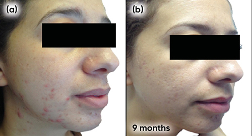 Figure 9 Case study 4 improvement on right-hand side of face, baseline to 9 months (a) Baseline (b) 9 months with COC (ethinylestradiol 0.02mg plus drospirenone 3mg) plus spironolactone 25mg twice a day, plus AZA gel 15% twice daily.