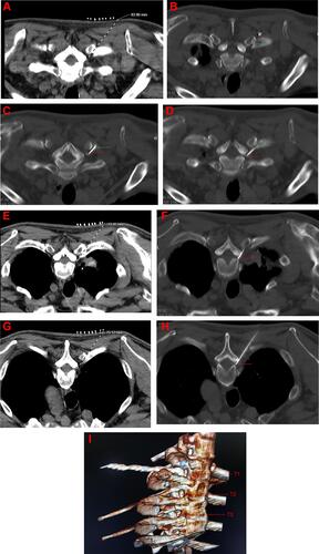 Figure 1 (A, E and G) CT-guided path design for T1, T2, and T3 puncture; (B) the tip of the puncture needle reached the T1 costal transverse joint; (C) the puncture needle have successfully crossed the costal transverse joint; (D, F and H) CT images of T1, T2, and T3 puncture, finally and respectively; (I) CT three-dimensional reconstruction of T1, T2, T3 puncture.Notes: The red arrow indicates the current position reached by the puncture needle, and the green arrow indicates the costal transverse process joint.Abbreviations: T1, the intervertebral foramen of the first thoracic vertebra; T2, the intervertebral foramen of the second thoracic vertebra; T3, the intervertebral foramen of the third thoracic vertebra.