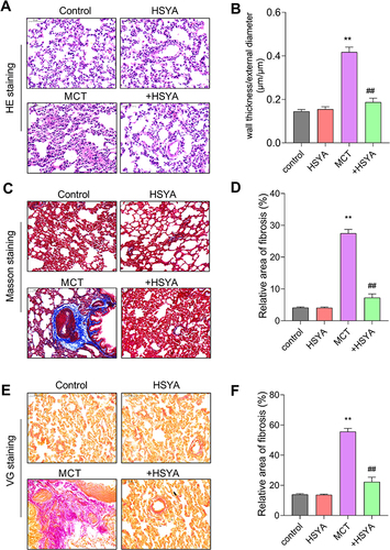 Figure 6 The effect of HSYA on pulmonary vascular remodeling and collagen deposition in lung tissues of PAH rats. (A) Morphological analysis was performed by HE staining in lung tissue; (B) Quantification of the ratio of pulmonary artery wall thickness to vessel diameter in (A); (C) Masson staining in lung tissue; (D) Quantification of the fibrosis area in (C); (E) VG staining in lung tissue; (F) Quantification of the fibrosis area in (E). All values were expressed as mean±SEM. n=10, **P<0.01 vs control, ##P<0.01 vs MCT.