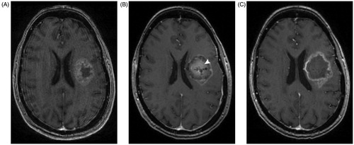 Figure 1. Pre- and post-operative MRI from a patient treated with laster interstital thermal therapy. A patient with glioblastoma underwent left-sided LITT. (A) Preoperative T1 MRI with contrast shows a rim-enhancing lesion with central hypointensity. (B) MRI performed 1 day after LITT shows the characteristic targetoid appearance of a lesion treated with LITT, with an area of central enhancement surrounded by a hyperintense rim. White arrowhead points to the area of central contrast-enhancement that was not present prior to treatment. (C) MRI performed 2 months later shows resolution of the central enhancement seen post operatively.