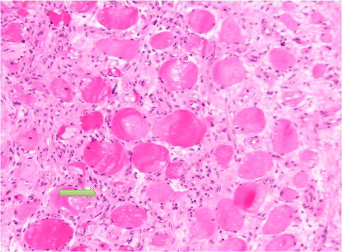 Fig. 4 Showing proliferative myositis with expanded myxoid connective tissue with inflammatory cells (yellow arrow). The appearance is also described as checkerboard appearance.