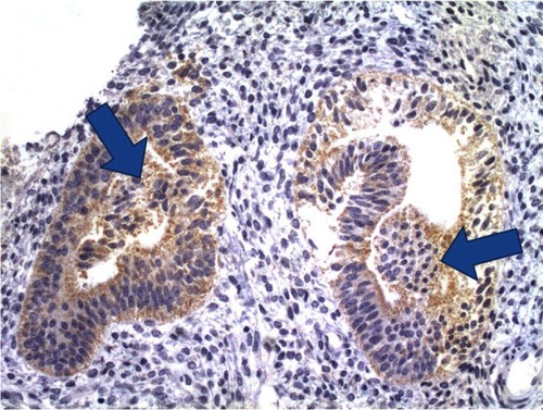 Figure 1 Aromatase expression in the glandular epithelium of the endometrium, in a patient with a normal uterus and symptoms of menorrhagia. Arrows point to areas of aromatase expression in the glandular epithelium.