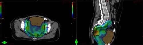 Figure 1 Computed tomography image showing isodose curves during external beam radiation therapy of a cervical cancer patient.