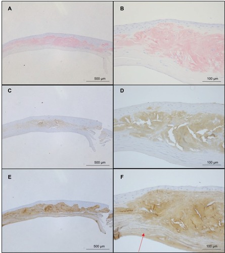 Figure 4 Comparison of staining by Congo red, anti-lactoferrin antibody, and anti-TGFBIp antibody.