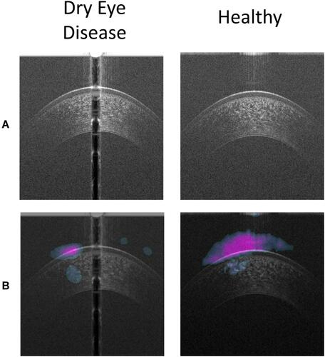 Figure 4 Results of the occlusion testing showing features of the OCT image recognized by the deep learning model. (A) AS-OCT images of a cornea with dry eye disease on the left and a healthy cornea on the right with (B) visualization of the learned features of the deep learning neural network.