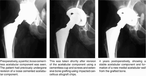 Figure 2. Case 9. Revision of a loose acetabular component in a patient with juvenile rheumatoid arthritis.