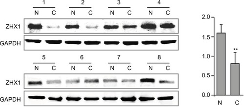 Figure 6 ZHX3 protein levels were determined by Western blot analysis in primary breast cancer tissues (C) vs matching adjacent noncancerous tissues (N).Notes: A quantitative analysis of ZHX3 expression normalized by β-actin is shown in the right panel (n=20). **P<0.01.