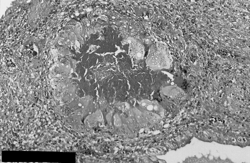 Figure 2. Granulomatous inflammation composed of numerous giant cell, inflammatory cells and macrophages in submucosa. Haemotoxylin and eosin stain: Bar=100 μm.