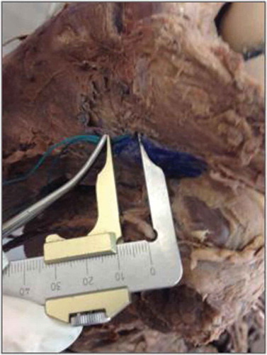 Figure 3. Hemostatic forceps placed on the suture thread, 1 cm from the tibial cortex with the knee in flexion.Source: Anatomy Laboratory–UNIRIO, 2015.
