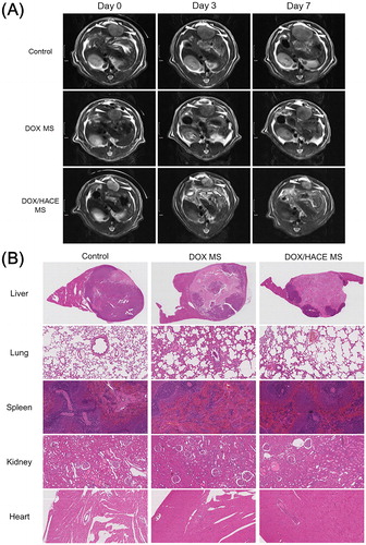 Figure 6. In vivo anticancer activities in the McA-RH7777 tumor-implanted rat model. (A) Serial MR images of liver tumors in control (sham operation), DOX MS, and DOX/HACE MS groups on day 0 (pre-treatment status), 3, and 7 after IA administration. White arrowheads in MR images indicate liver tumor. The length of scale bar in the left side is 1 cm. (B) H&E staining images of dissected liver and tumor, lung, spleen, kidney, and heart in control, DOX MS, and DOX/HACE MS groups. The length of scale bar (shown in the lower right side) in the images of lung, spleen, kidney, and heart is 100 μm.