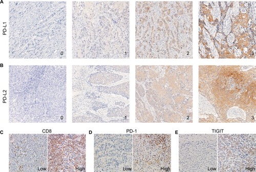 Figure 1 Expression patterns of PD-L1, PD-L2, CD8, PD-1, and TIGIT in ESCC samples.Notes: (A and B) Representative immunohistochemical images of PD-L1 and PD-L2 expressions, which were scored from 0 to 3+. Cases displaying scores of 0 or 1+ were considered negative for PD-L1 and PD-L2 expressions, whereas those displaying scores of 2+ or 3+ were considered positive (original magnification, 200×). (C–E) Representative immunohistochemical images from cases with low vs high numbers of CD8+, PD-1+, and TIGIT+ TILs (original magnification, 200×).Abbreviations: ESCC, esophageal squamous cell carcinoma; TILs, tumor-infiltrating lymphocytes.