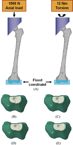 Figure 1. Finite element model of a femur with loading and boundary conditions (A) and four different modes of pin penetration in tubular bone: unicortical (B), bicortical (C), half-bicortical, (D) and transcortical (E).