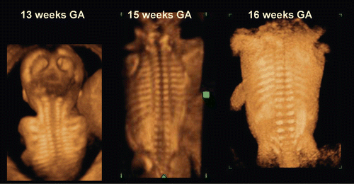Figure 6.  3D reconstructed image of fetal vertebral development between 13 and 16 weeks of gestation.