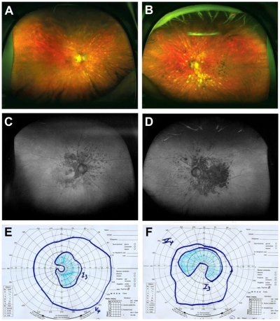 Figure 1 Case 1: (A, B, C, and D) Optomap color fundus imaging (A and B) and wide-field FAF (C and D) of the right (A and C) and left eye (B and D). (E and F) corresponding visual fields measured with Goldmann manual perimetry. The nasal paracentral scotoma of the right eye, and the large scotoma extending from the blind spot nasally on the left eye correspond well with the areas of reduced FAF.