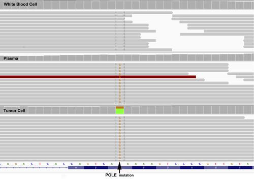 Figure 2 Integrative genomics viewer (IGV) screenshots displayed the chimeric reads from targeted sequencing, somatic POLE F367S mutation by frequency as 29% in tumor cells, 4% in plasma, and 0% in white blood cells.