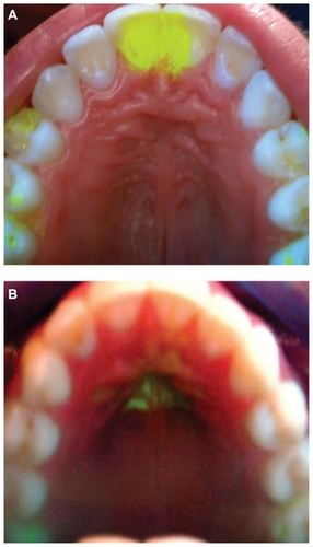 Figure 2 (A) Lingual apex positioned at the upper incisors and (B) repositioning of the lingual apex to the normal lingual apex position.