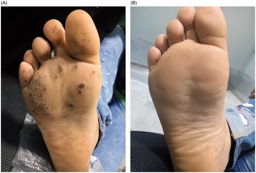 Figure 1. Multiple planter warts at right sole. (A) Before treatment. (B) After six settings of intralesional Candida antigen immunotherapy.