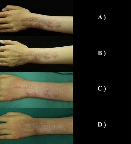 Figure 3 Various stages of treatment for Case 3. (A) Baseline; (B) 2M: Before the second treatment; (C) 4M: Before the third treatment; (D) 6M: Treatment endpoint.