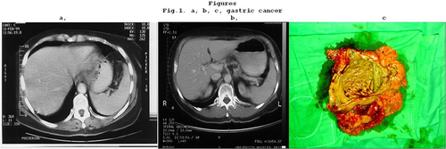 Figure 1 (a) T4 gastric cancer demonstrated by CT. (b) CT after chemotherapy shows complete clinical response. (c) Surgical specimen. Normal mucosa can be seen and the histology confirms a pCR.