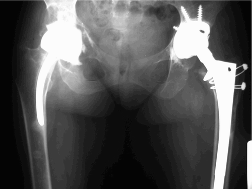 Figure 1C. The left hip was revised using a cementless porous-coated acetabular cup with screws and impacted cancellous allograft bone chips, and a cementless extensively porous-coated femoral component. A sliding trochanteric osteotomy was used for enhanced exposure.