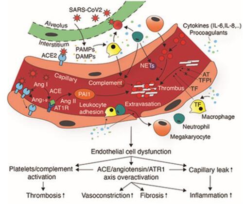 Figure 3 Pathogenesis of thrombotic complications of COVID-19. SARS-CoV2 infection induces endothelial damage triggering endothelial release of cytokines, increasing capillary permeability. PAMPs and DAMPs induced activation of neutrophils, and macrophages results in localized production of cytokines, procoagulants, and complement activation, leading to further endothelial damage and tissue factor release. Endothelial damage exposes collagen and other prothrombotic mediators leading to thrombus formation.