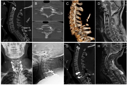 Figure 1 Imaging examinations of case 1. (A) Sagittal image of the cervical spine CT demonstrated grade III spondylolisthesis of C7. (B) Axial image of C7 displayed bilateral fractures at the junction of the bilateral lamina and pedicle. (C) Three-dimension reconstruction image of the cervical spine. (D) MRI of the cervical spine showed mild compression and no edema signal of the spinal cord. (E–H) Postoperative X-ray films, CT and MRI showed that the cervical spine was well realigned and compression of the spinal cord was relieved