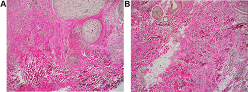 Figure 7 Biopsies of subject treated with RSN showing almost completely absent elastic fibers in the center of the specimen, in both the superficial and deep dermis pre-treatment (A), but on day 90 the biopsy shows relatively normal elastic fibers in the papillary dermis with additional fibers in the reticular dermis (B).
