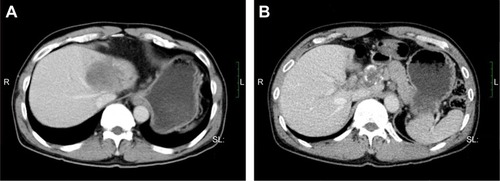Figure 3 Confirmation of tumor shrinkage. A CT scan on August 5, 2015, revealed the tumor to be smaller after chemotherapy. (A), lesion located in the left lobe of the liver, (B) lesion located in the para-aortic lymph node.
