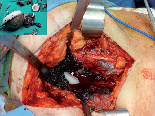 Figure 3. Intraoperative findings. Extensive periprosthetic metallosis and wear of the tantalum augment and the adjacent porous titanium and hydroxyapatite-coated acetabular SYMBIOS cup. Ta particles were embedded in the polyethylene surface (black stains).