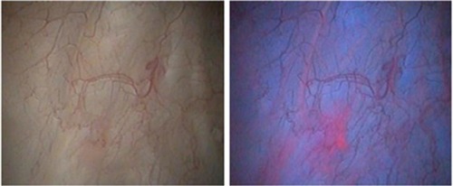 Figure 1 Cystoscopic appearance of bladder tumors under white light (left) and blue light (right). Images are from a 75-year-old man with a 4-year history of bladder cancer (most serious diagnosis Ta grade 1), who was found to have carcinoma in situ on follow-up flexible cystoscopy that was clearly visible under blue light. Image credit: Reza Zare, MD, Urologist, Head of Urology Department, Bærum Hospital Vestre Viken HF, Oslo, Norway.
