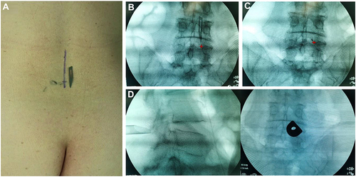 Figure 3 Location of skin entry point and placement of U-shaped cannula. (A–C) The entry point was marked and puncture was performed with C-arm fluoroscopy assistance. (D) The final position of U-shaped cannula was determined on posteroanterior and lateral view of C-arm fluoroscopy.