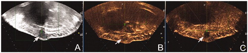 Figure 1. Ultrasound and contrast-enhanced ultrasound imaging (from the guiding ultrasound device of the high-intensity focussed ultrasound[HIFU] unit) in a 36-year old woman with abdominal wall endometriosis (AWE). (A) Before HIFU, a hypoechoic nodule (25 × 20 mm) between the subcutaneous fat layer and rectus abdominis (distance from skin surface, 5 mm) (white arrow). (B) Before HIFU, the nodule was enhanced oncontrast-enhanced ultrasoundafter contrast agent injection (white arrow). (C) One day after HIFU, the nodule was ablated with complete absence of perfusion (white arrow), and cyclic pain disappeared. The nodule disappeared and no recurrence occurred during the 3-year follow-up.