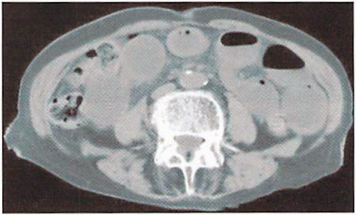Figure A.5. Abdominal plain computed tomography (case 5).