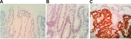 Figure 1 Immunohistochemical staining to observe the expression of mutant p53 protein in differentiated gastric adenocarcinoma and adjacent tissues (400×). (A) Mutant p53 protein was not expressed in paracancerous tissues. (B) The low expression of mutant P53 protein in differentiated adenocarcinoma. (C) The high expression of mutant P53 protein in differentiated adenocarcinoma.