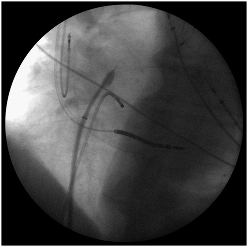 Figure 1. Transseptal puncture in a patient with cardiac resynchronization therapy (CRT) device. In absence of a diagnostic catheter in coronary sinus the left ventricle lead was used as a landmark for the puncture (LAO 30° projection).