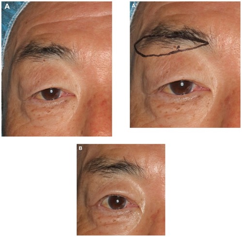 Figure 5 Case 2. (A) A 56-year-old man with severe bilateral dermatochalasis. He had a sleepy looking appearance due to droopy eyelids. Lateral hooding impaired the upper visual field. The maximum width of eyebrows was 1 cm. (A′) Extended IBEB with FUT was carried out, where the maximum width of the excised skin pad was 20 mm. The numbers of follicular units available to transplant were 150 on each side, and these were transplanted into the upper part of the eyebrow from body to tail. (B) Twelve months after the operation, the decline and reduction of the eyebrow was slight and the patient was able to open his eyes easily. The maximum width was not as variable as before the operation at 1 cm. He was satisfied with the result and no complications were observed.