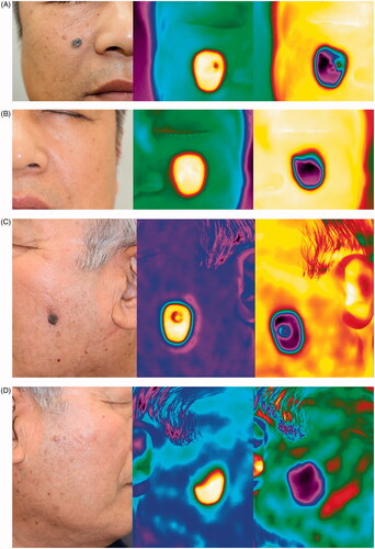 Figure 1. Representative clinical photographs and thermal images. (A) Pigmented basal cell carcinoma (BCC); clinical photo (left), the thermal image immediately after removal of the heat stimulus (middle), and the thermal image immediately after removal of the cold stimulus (right). (B) The contralateral control site of pigmented BCC; clinical photo (left), the thermal image immediately after removal of heat stimulus (middle), and the thermal image immediately after removal of cold stimulus (right). (C) Seborrheic keratosis (SK); clinical photo (left), the thermal image immediately after removal of heat stimulus (middle), and the thermal image immediately after removal of cold stimulus (right). (D) The contralateral control site of SK; clinical photo (left), the thermal image immediately after removal of heat stimulus (middle), and the thermal image immediately after removal of cold stimulus (right).