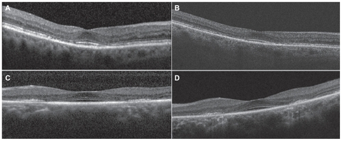 Figure 2 Spectral domain optical coherence tomography (SD OCT) images taken with different commercially available SD OCT machines demonstrate the “flying saucer” sign is consistent in different individuals with hydroxychloroquine retinopathy. A) Heidelberg Spectralis SD OCT in patient 9, OD. B) Zeiss Cirrus SD OCT in patient 9, OD. C) Heidelberg Spectralis SD OCT in patient 4, OS. D) Zeiss Cirrus SD OCT in patient 4, OS.