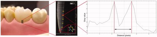 Figure 2. Details of measurement method: black lines cervically on the ceramic crown placed on the abutment tooth indicate the area for OCT imaging (left). B-scans (center) were obtained from five sites at the facial surface, 250 µm apart. On the B-scans, measurement sites were defined. Lines delimiting the marginal horizontal (a) and vertical (b) discrepancies were used to calculate the absolute marginal discrepancy (c), and measurement areas were delimited for assessment of internal fit. The internal cement gap was defined as the distance between two peaks on the gray value intensity plot (right).