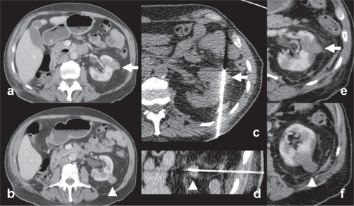 Figure 2 Example of radiofrequency ablation of renal cell carcinoma. (a–b) An 86-year-old male patient with solitary left kidney (history of unilateral nephrectomy for renal cell carcinoma (RCC) 5 years ago) presented with 2 small exophytic renal tumors (white arrow and arrowhead). Percutaneous biopsy confirmed the histological diagnosis of RCC. (c–d) Percutaneous RFA of the two lesions under CT guidance (Cool-tip Valleylab RFA system, Tyco Healthcare, Hampshire, United Kingdom). Note the insertion of the RFA electrodes into the tumors (e–f) follow-up imaging show absence of contrast enhancement, congruent with complete tumor necrosis (white arrow and arrowhead).