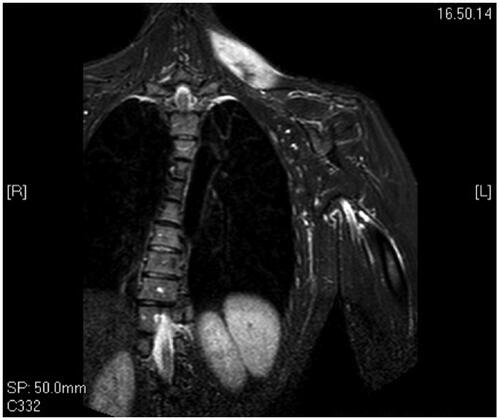 Figure 1. Pre-operative MRI shows the mass in the upper third of the trapezius.