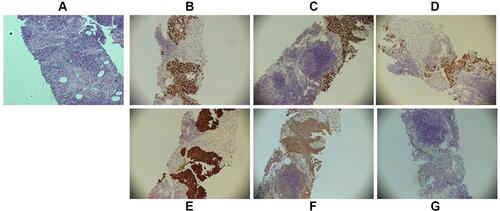 Figure 5 Results of left inguinal lymph node biopsy revealed that nested mass cancer cells were present (A) (HE stain ×100). Cancer cells in the inguinal lymph node were positive for GATA-3 (B), P40 (C), CK20 (D), CK7 (E), partially positive for Villin (F) and negative for CDX2 (G) (Immunohistochemical stain ×100).