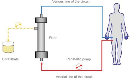 Figure 2 Principle of ultrafiltration using a veno-venous extracorporeal circuit. Reproduced with permission Springer Am J Cardiovasc Drugs. Continuous ultrafiltration in acute decompensated heart failure: Current issues and future directions. 2015;15(2):103–112. Marenzi G, Morpurgo M, Agostoni P.Citation17 © Springer International Publishing Switzerland 2015 with the permission of Springer.