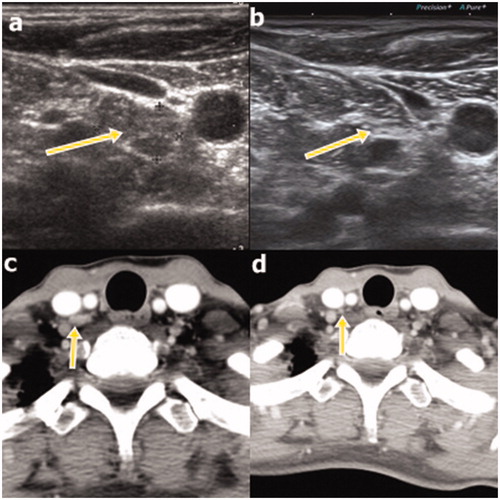 Figure 2. Ultrasound (US; a) and computed tomography (CT; c) images obtained at the initial radiofrequency ablation procedure in a 51-year old woman with recurrence at right cervical level 4 (a and c, respectivelyarrows). The recurrent lesion completely disappeared at the 98-month follow-up, as observed on US (b), and had also disappeared at the 5-month follow-up, as observed on CT (d; arrows).