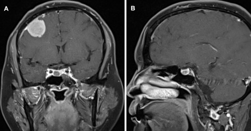 Figure 1 Enhanced magnetic resonance imaging (MRI) of the patient’s head: (A) Coronal view of the gadolinium-enhanced T1-weighted image showing a spherical enhancing mass in the right frontal convexity and a dural tail sign. A round low-intensity lesion can be seen on the right side of the pituitary gland, and the pituitary stalk is displaced to the right. (B) Sagittal T1-weighted sequence with contrast showing the degree of enhancement is lower than that of the pituitary in the sellar region.