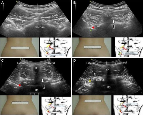 Figure 6 The horizontal planes for the cranial sacrum (A), alae of the sacrum (B), bilateral L4/L5 facet joints (C), and waist of the L4 lamina (D).