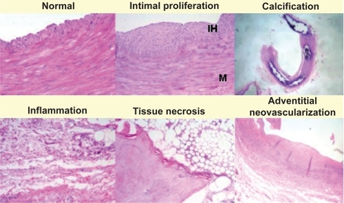 Figure 2 Representative sections of the radial artery showing different histopathological findings encountered in the study.