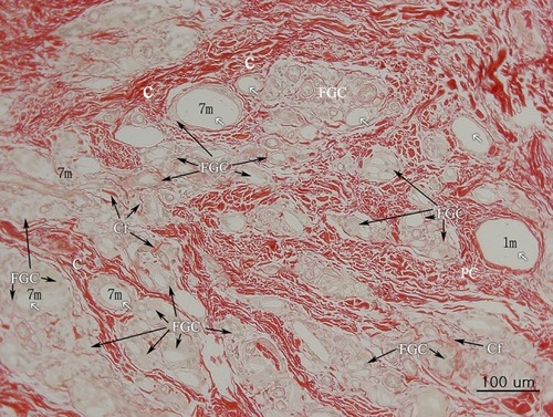 Figure 14 Non polarized PSR staining (100×). Collagen stained red. Pre existing collagen (Pc) showed regular arrangements, whereas thicker irregular patterned matured and reinforced collagen fibers (C) were thicker, denser, and differed in shape and arrangement. A thin, pinkish, and single layer (Cf) was visible around a recently injected particle (1 m) and between FGCs, suggesting a recently made collagen fiber. Abundant Very thin and new collagen fibers (Cf) were observed between FGCs.