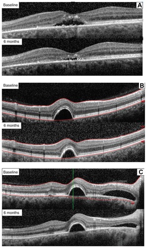 Figure 3 Retinal thickness after 6 months of treatment with the curcumin-lecithin formulation in three different cases. (A) Case 1, reduction of a subfoveal neuroretinal detachment. (B) Case 2, reduction of a juxtafoveal retinal pigment epithelium detachment and extrafoveal neuroretinal detachment. (C) Case 3, reduction of a juxtafoveal retinal pigment epithelium and extrafoveal neuroretinal detachment.